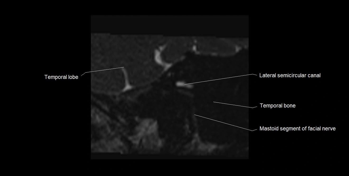 Internal auditory meatus (IAM) 3T sagittal cross sectional anatomy image 2.webp